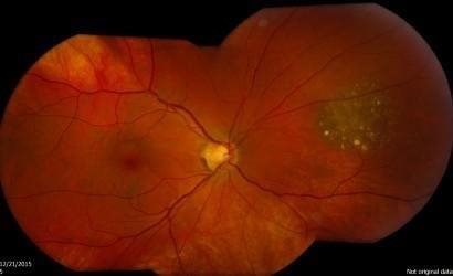 choroidal nevus with red free filter